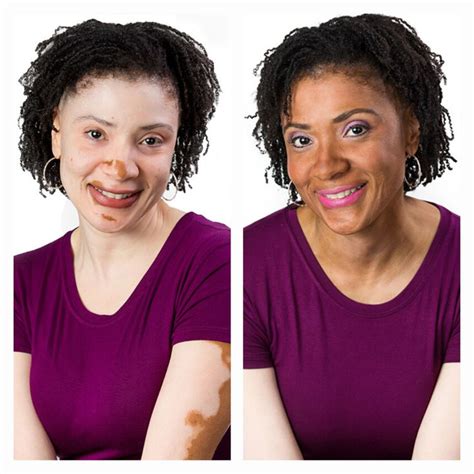 Vitiligo Makeup Concealer And Camouflage Vitiligo Vitiligo Makeup