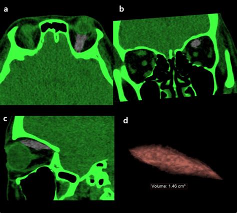 Multiplanar Three Dimensional Reconstruction Of A Computed Tomography