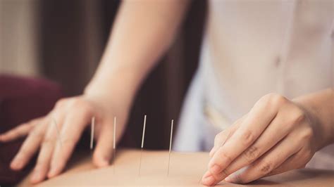 Acupuncture For Back Pain What To Know About This Pain Relief Option