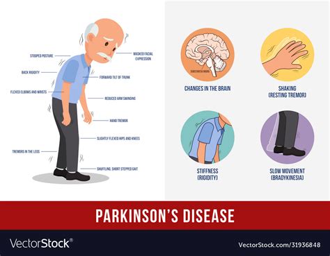 Parkinsons Disease Royalty Free Vector Image Vectorstock