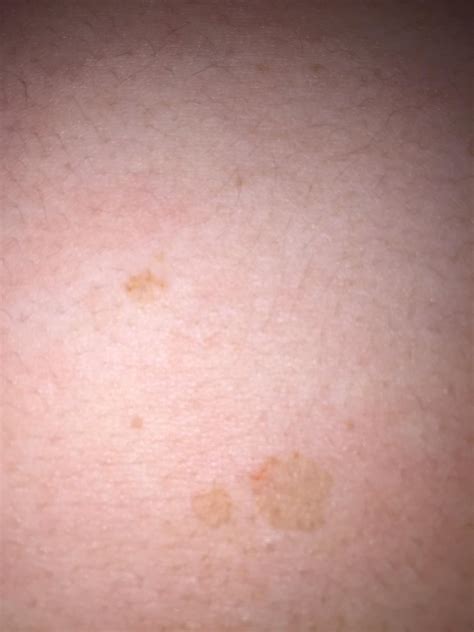 Skin Concerns Strange Permanent Little Spots Have Appeared On My