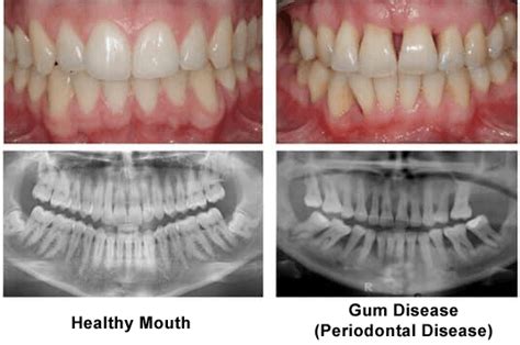 Gum Disease Treatment Tampa Fl The Hyde Park Center For Aesthetic