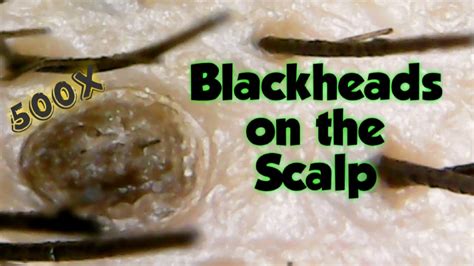 Blackheads Removal On The Scalp Close Up500x Youtube