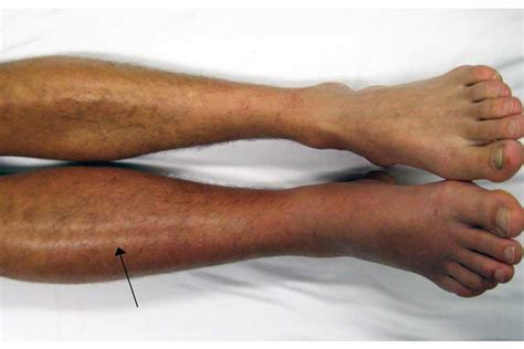 Soms kan plotse sterfte optreden. Pulmonary embolism Symptoms and Causes