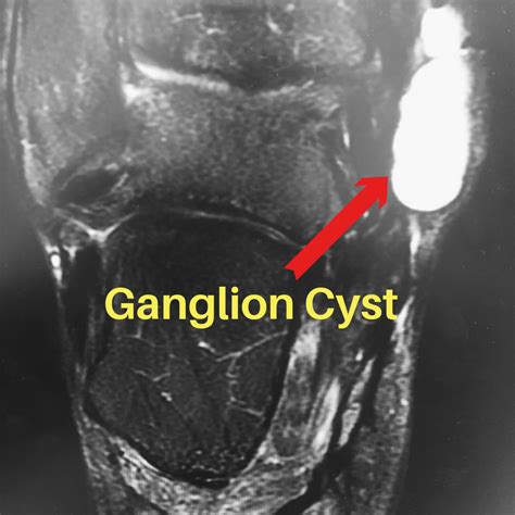 What Is A Ganglion Cyst Of The Ankle And Foot Final Kick Ankle And Foot Clinic Ankle Foot