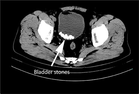 Frontiers Sexual Dysfunction In Patients With Urinary Bladder Stones But No Bladder Outlet