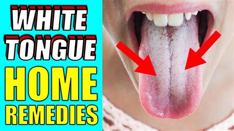 What Causes White Tongue How To Get Rid Of White Tongue Quickly Youtube