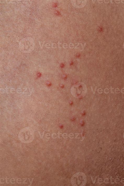 Allergic Reactions To Tick Bites 9231345 Stock Photo At Vecteezy
