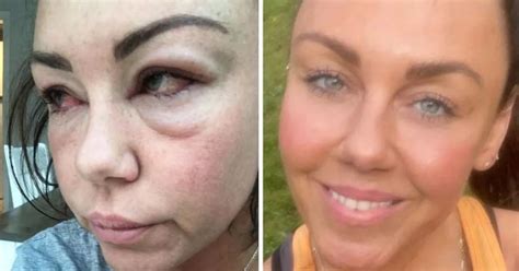 Michelle Heaton Shares Selfie Of Puffy Face And Bloodshot Eyes Amid