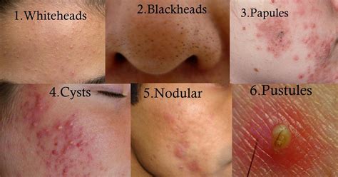 acne vulgaris is characterized by papules pustules and acne skin care back acne treatment