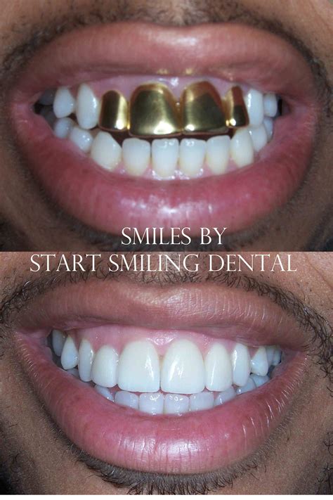Maybe you would like to learn more about one of these? Replacing Gold Crowns in Atlanta, Ga. This patient felt he had outgrown his gold grill and was ...