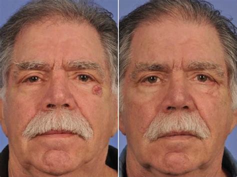 Facial Reconstruction Before And After W Cosmetic Surgery