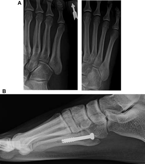 Proximal Fifth Metatarsal Fractures In Athletes Foot And Ankle Clinics