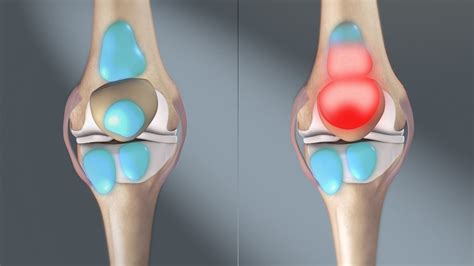 Prepatellar Bursitis Knee Pain Info