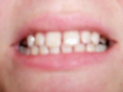 Teeth that are misaligned or crowded, teeth that have large gaps between them, and jawlines. How Long Would I Need Braces for Teeth Gaps? Dentist ...