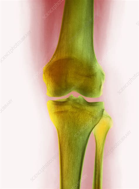 Healthy Knee X Ray Stock Image P1160745 Science Photo Library