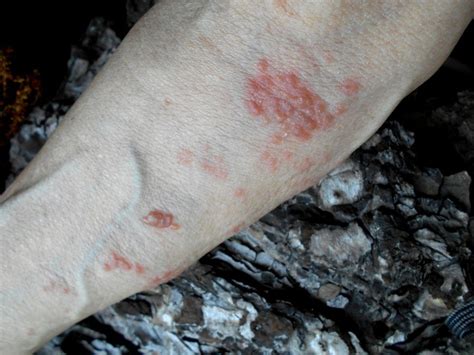 What 10 Common Skin Rashes Look Like