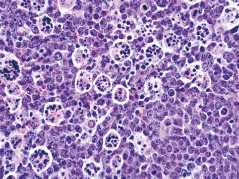 Burkitt Lymphoma Medium Size B Cell Lymphoma T814 C Myc