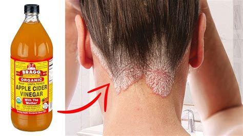 Scalp Fungus Causes Symptoms Treatments Home Remedies Scalp Otosection