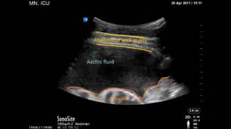 Ultrasound Guided Drainage Of Ascites Youtube