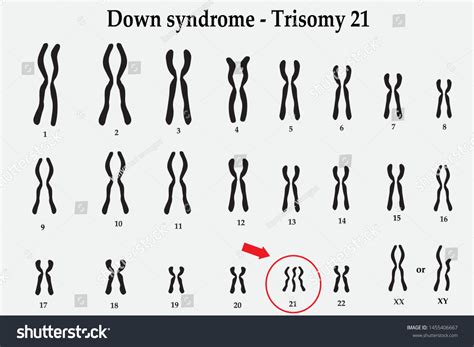 Karyotype Down Syndrome Ds Dns Known Stock Vector Royalty Free