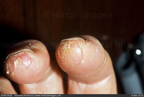 Stock Image Dermatology Psoriasis Cracked And Peeling Skin On The