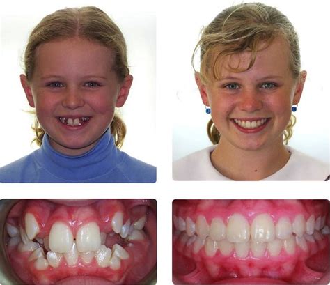 Aparat ortodontyczny przed i po