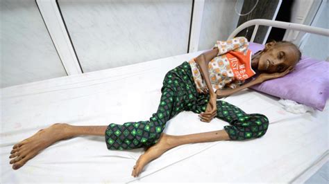 Los niveles de malnutrición, entre los niños, superan el 30%. Niños desnutridos en Yemen revelan crímenes de Arabia ...