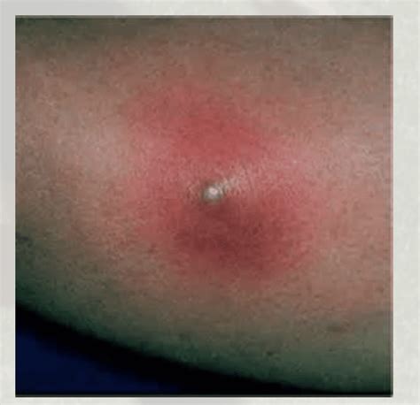 Collection 100 Pictures Identifying A Spider Bite By Pictures Sharp
