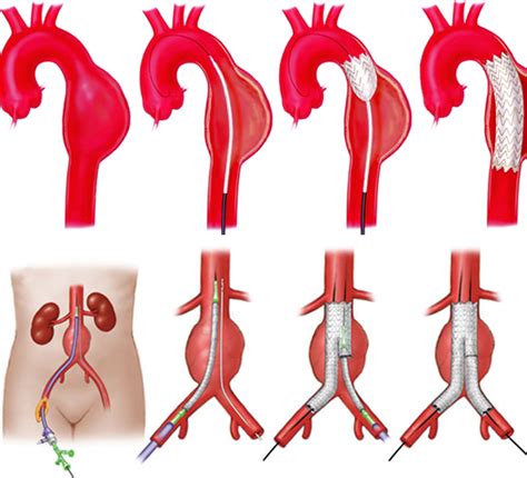 Aortic Aneurysm Varicose Veins Vascular Surgeon Stroke Dvt