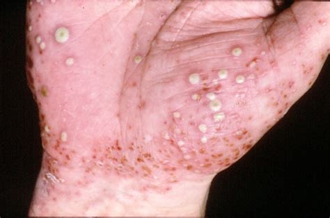 What Does Pustular Psoriasis Look Like And How Is It Different
