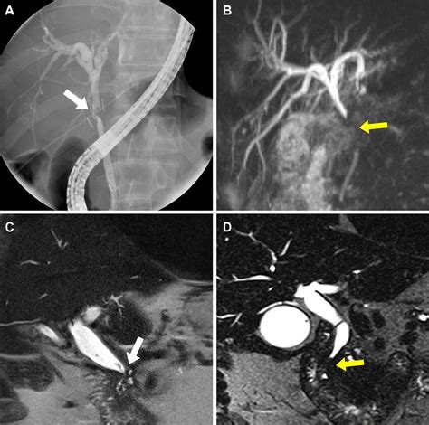 Benign And Malignant Strictures Of The Extrahepatic Ducts A Ercp