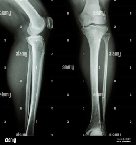 Knee Leg X Ray Hi Res Stock Photography And Images Alamy