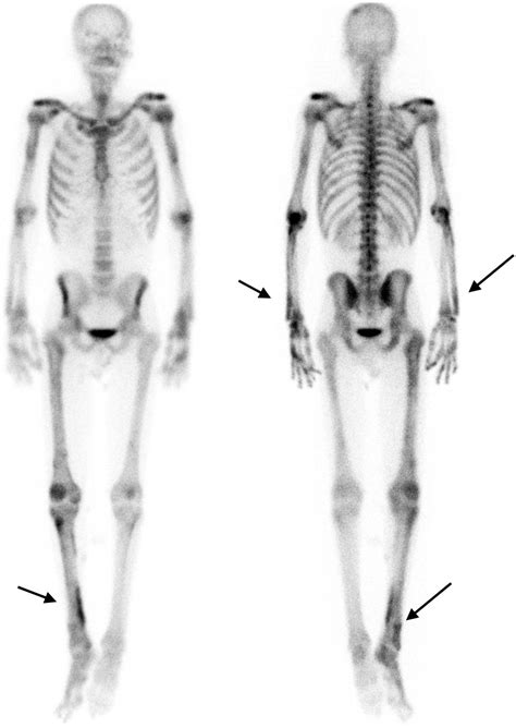 Hypertrophic Osteoarthropathy On Bone Scintigraphy Journal Of Nuclear
