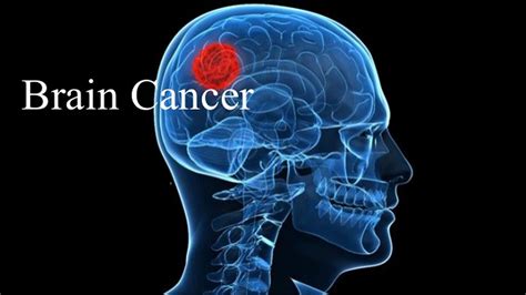 Brain Cancer Causes Treatmentsurvical Ratesymptomsstage