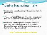 Internal Eczema Treatment