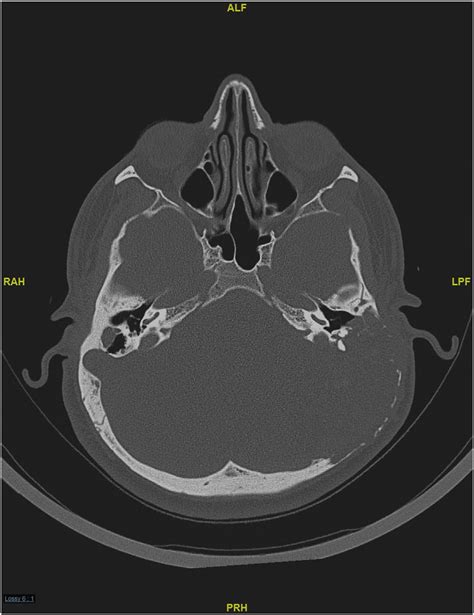 Computed Tomography Ct Scan Of The Temporal Bone Showing A Large