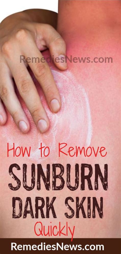 How To Get Rid Of Sunburn Dark Skin Overnight 10 Best Remedies For