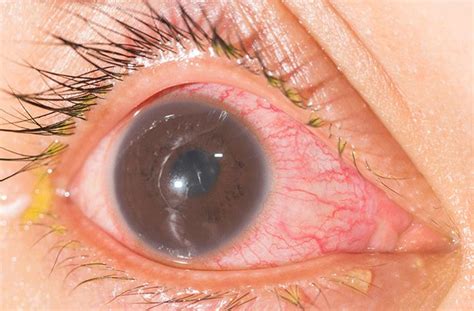 Iritis Inflammation Of The Iris