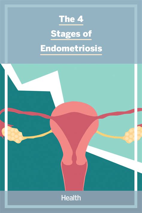 Nongenital endometriosis has been estimated to occur in 1% to 12% of patients with pelvic in fact, endometriosis has been reported in almost all body structures. There Are 4 Stages of Endometriosis. Here's What Each One ...