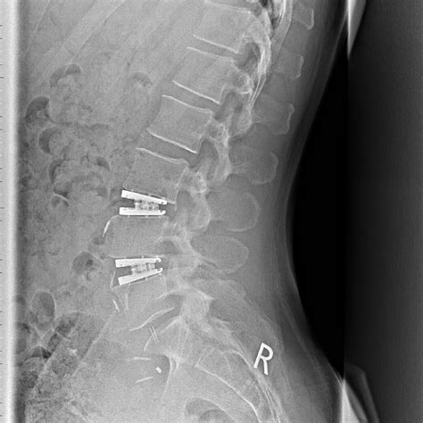 Artificial Disc Replacement Onz Spine