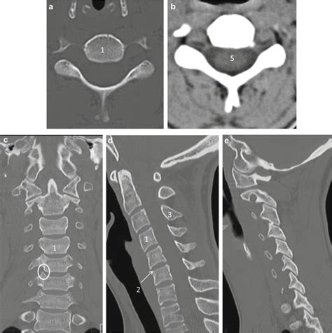 Cervical Spine Imaging Normal Anatomy And Degenerative Disease