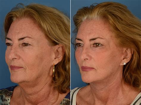 The Uplift™ Lower Face And Neck Lift Photos Naples Fl Patient 12782
