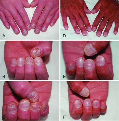 Clinical Manifestation Of Nail Psoriasis With Crumbling And