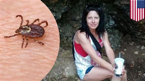 Oklahoma Woman Loses All Her Limbs After Tick Bite Causes Rocky