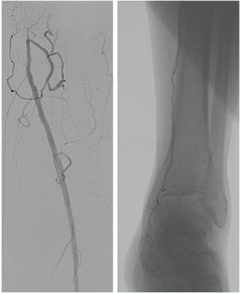 Endovascular Today Left Superficial Femoral Artery Occlusion In A