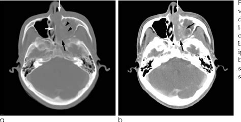 Figure 1 From Embryonal Rhabdomyosarcoma Of The Nasal Cavity In An