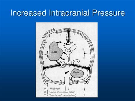 Increased Intracranial Pressure Pictures