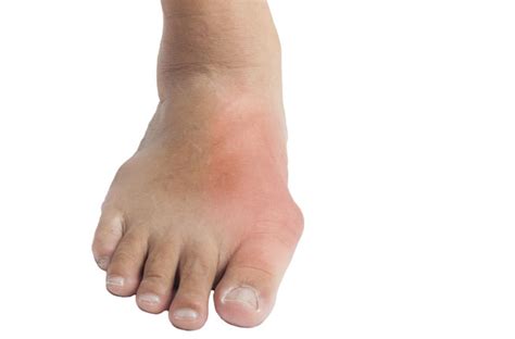 Gout Symptoms And Causes