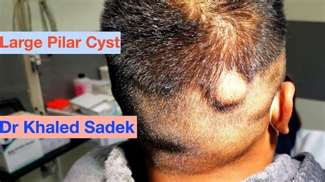 Massive 10 Year Pilar Cyst Comes Out Dr Khaled Sadek